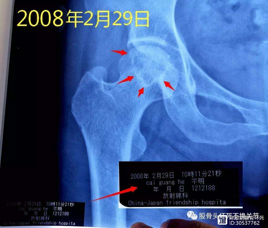 巴彦淖尔人工骨头医保报销多少(人工骨头医保报销多少比例)